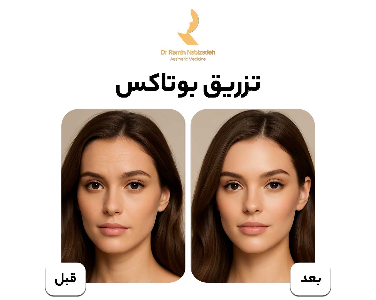 تزریق بوتاکس در تبریز