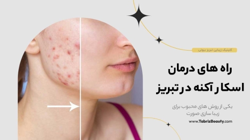 درمان اسکار آکنه در تبریز