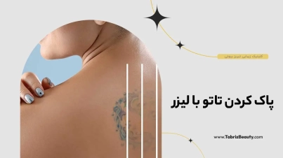 پاک کردن تاتو با لیزر