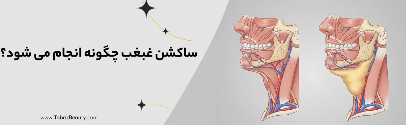 ساکشن غبغب چگونه انجام می شود؟