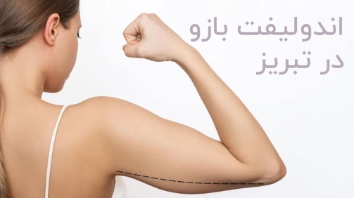 اندولیفت بازو در تبریز