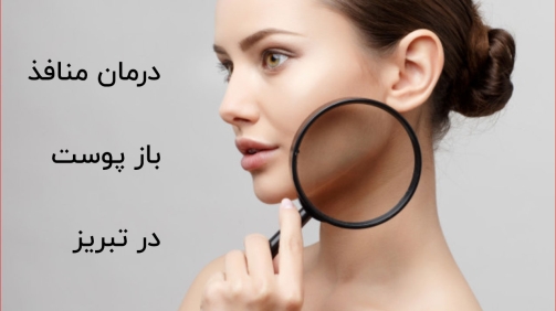 درمان منافذ باز پوست در تبریز