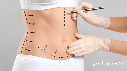 ابدومینوپلاستی چیست