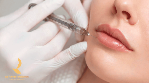 در تزریق ژل لب مدل چاک‌‌ دار