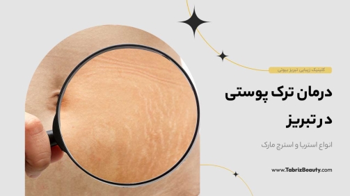 درمان ترک پوستی در تبریز