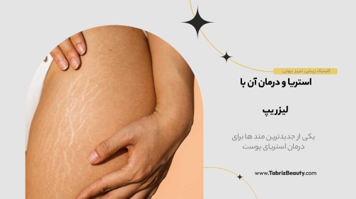 استریا ( استرچ مارک )
