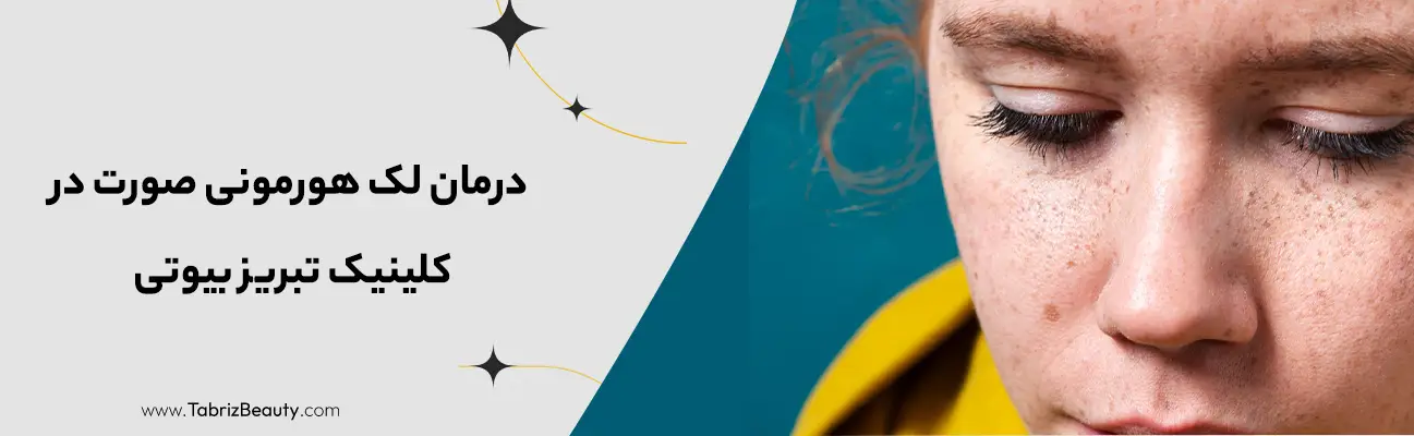 درمان لک هورمونی صورت در کلینیک تبریز بیوتی