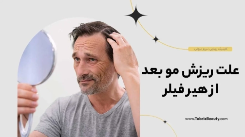 علت ریزش مو بعد از هیر فیلر