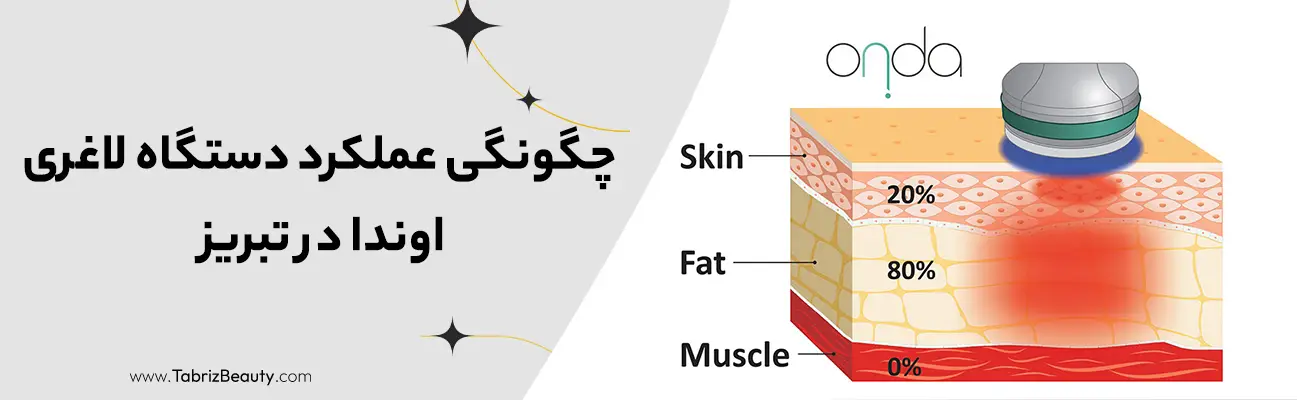 چگونگی عملکرد دستگاه لاغری اوندا در تبریز